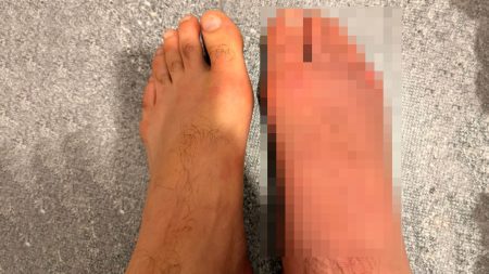 MMA star’s gruesomely swollen foot looks ‘like a balloon’ after savage head kick KO