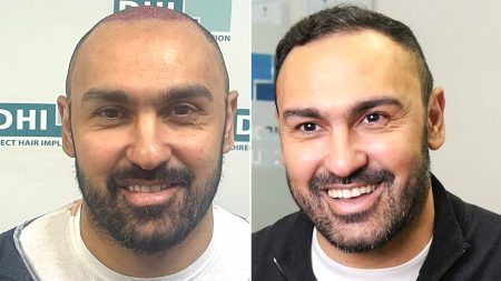 Premier League cult hero looks unrecognisable after hair transplant as he says ‘I feel five years younger’